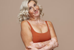 Vitiligo: o que é mito e verdade sobre a doença?